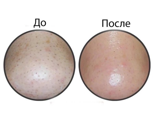 Салфетки для удаления черных точек Ciracle Blackhead Off Sheet